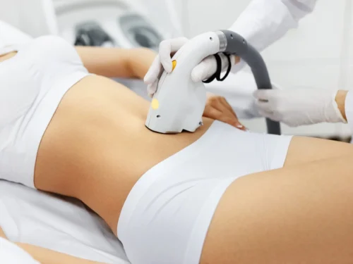 Lazerinė depiliacija. Depiliacija lazeriu – šiuolaikinė ir itin efektyvi plaukelių šalinimo technologija, paremta lazerio šviesos naudojimu.