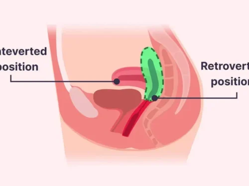 Kaip greitai pastoti, kai gimda yra apsisukusi: Atsakymai į svarbiausius klausimus
