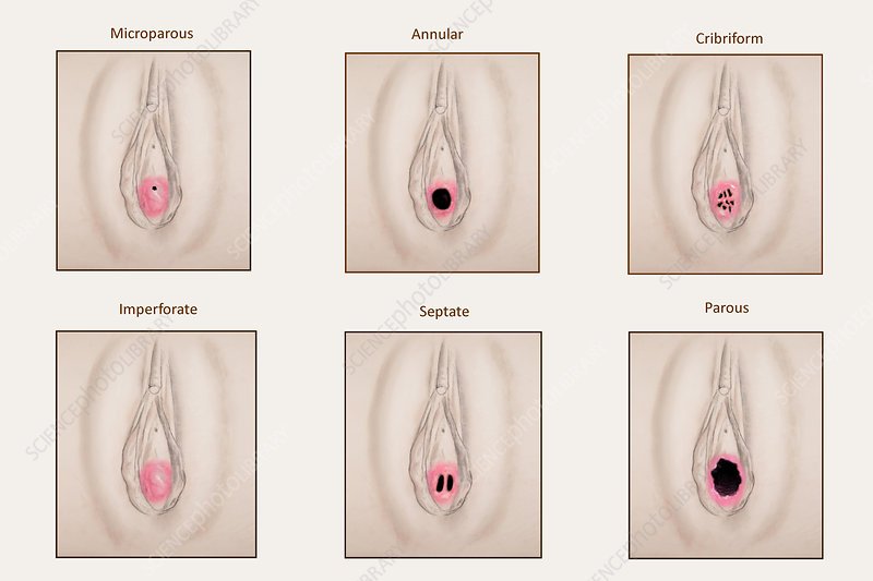 Kas yra mergystės plėvė ir kodėl ji reikalinga: faktai apie moters anatomiją, kuriuos naudinga žinoti kiekvienam. „Nekaltybės“ sąvoka turi sudėtingą istoriją.