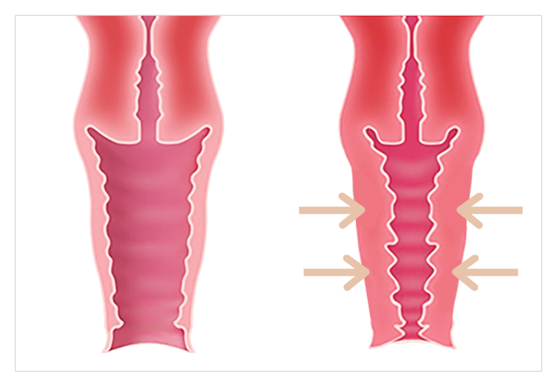 Makšties siaurinimas. Sumažėjęs makšties sienelės stangrumas yra itin dažna, tačiau viešai nediskutuotina problema, sukelianti ne tik fizines, bet ir psichologines problemas.