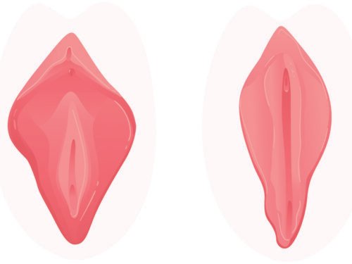 Lytinių lūpų korekcija. Lytinių lūpų plastika – tai plastinė estetinė operacija, kurios tikslas yra sumažinti mažąsias, rečiau didžiąsias lytines lūpas ar klitorį.