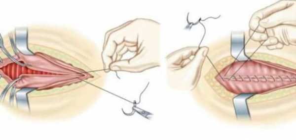 Kodėl moterims atliekama himenoplastika?? Kodėl moterims atliekama himenoplastika??