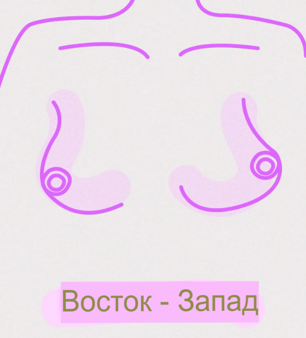 Pasaulyje yra 8 skirtingų tipų krūtys – štai ką reikia žinoti. 3. Rytai-Vakarai