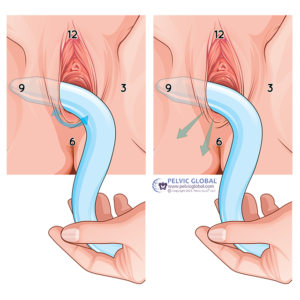 Pelvic Floor Rehabilitation
