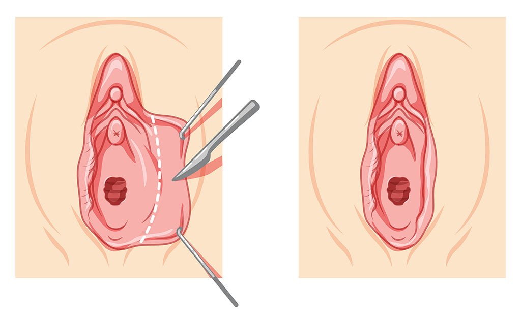 Effective Solutions On How to Get Rid of Extra Skin on Vaginal Lips