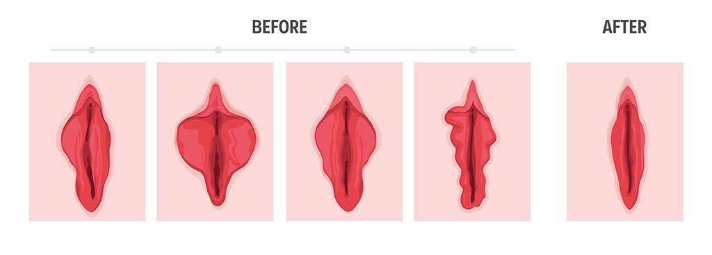 Types of Vaginal Lips