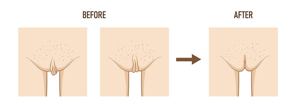 Labial Hypertrophy And Its Classification