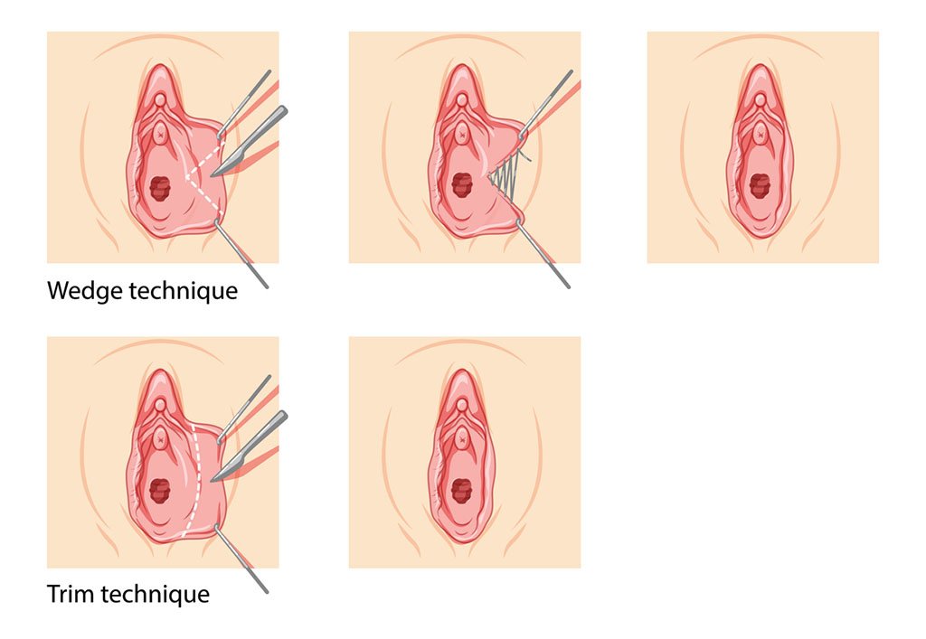Surgical Option For Labial Hypertrophy