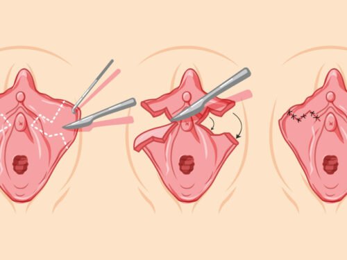 Mažųjų lytinių lūpų plastika. Mažųjų lytinių lūpų plastika atliekama esant per didelėms, asimetriškoms ar po gimdymo traumos blogai sugijusioms lytinėms lūpoms.